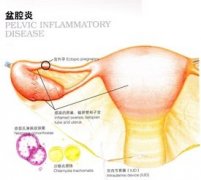 患有盆腔炎会不会导致不孕呢