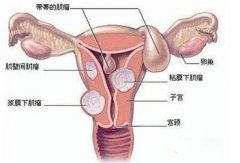 得了子宫肌瘤可以怀孕吗?