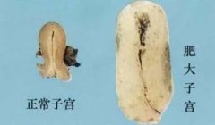 子宫肥大是怎么一回事呢?