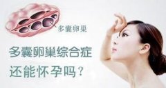 中医治疗多囊卵巢综合症，效果好吗?