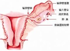 双侧卵巢多囊改变是怎么一回事?