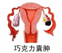 巧克力囊肿手术要多少钱?