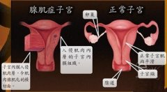 子宫腺肌症有哪些常见的症状呢?