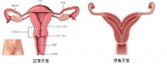 双角子宫是怎么一回事呢?