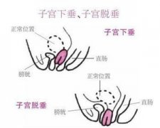 子宫下垂怎么治疗?
