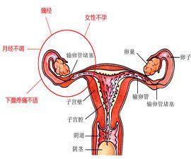 哪些症状显示输卵管堵塞呢?