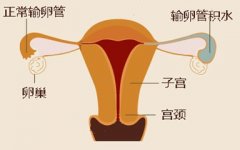 流产一定会输卵管积水吗?