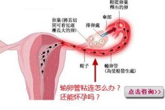 输卵管粘连怎么治疗比较好