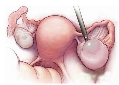 治疗抗滋养层细胞膜抗体多少钱