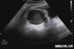 子宫内膜回声不均匀