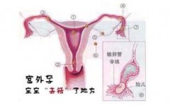 宫外孕必须手术吗