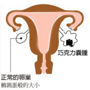 巧克力囊肿会导致不孕吗？