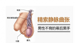 精索静脉曲张如何导致不育